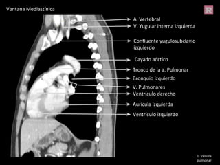 Ventrículo izquierdo
Tronco de la a. Pulmonar
Aurícula izquierda
Ventrículo derecho
Bronquio izquierdo
V. Pulmonares
Cayado aórtico
V. Yugular interna izquierda
Confluente yugulosubclavio
izquierdo
A. Vertebral
1
1. Válvula
pulmonar
Ventana Mediastínica
 