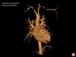 Estructuras vasculares
Reconstrucción 3D
 