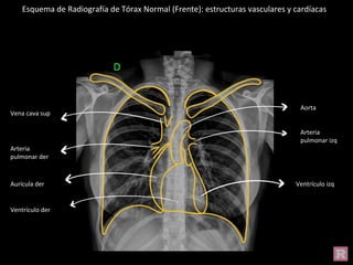 Esquema de Radiografía de Tórax Normal (Frente): estructuras vasculares y cardíacas
Vena cava sup
Arteria
pulmonar der
Aurícula der
Ventrículo der
Aorta
Arteria
pulmonar izq
Ventrículo izq
 