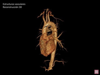 Estructuras vasculares
Reconstrucción 3D
 
