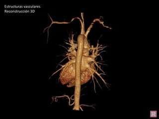 Estructuras vasculares
Reconstrucción 3D
 