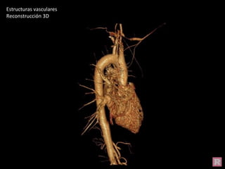 Estructuras vasculares
Reconstrucción 3D
 