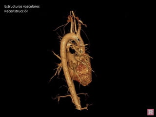 Estructuras vasculares
Reconstrucción 3D
 