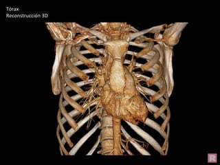 Tórax
Reconstrucción 3D
 