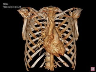 Tórax
Reconstrucción 3D
 