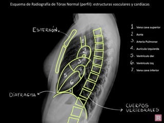 Esquema de Radiografía de Tórax Normal (perfil): estructuras vasculares y cardíacas
 