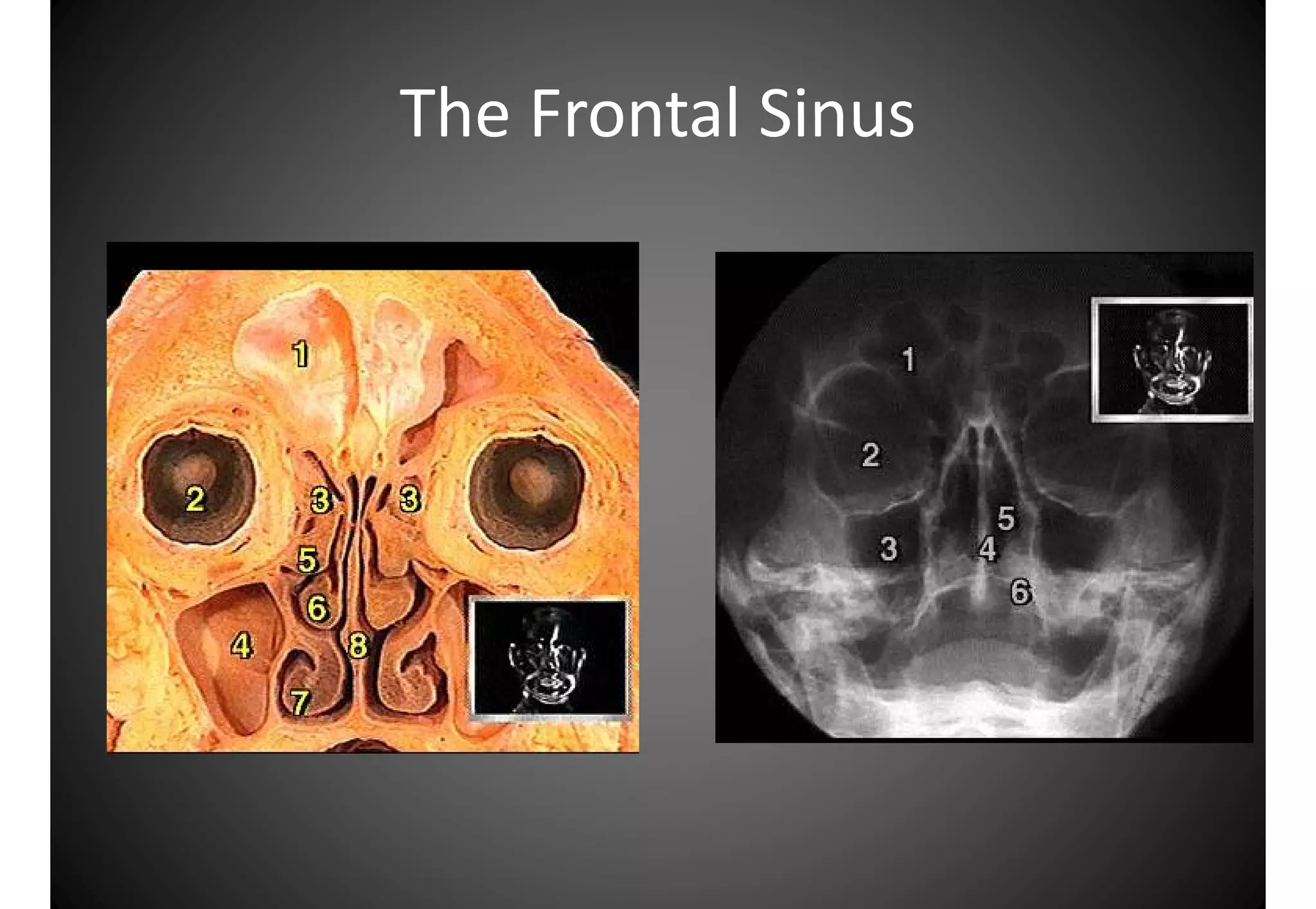 Atlas anatomy of the nose and paranasal sinuses | PDF