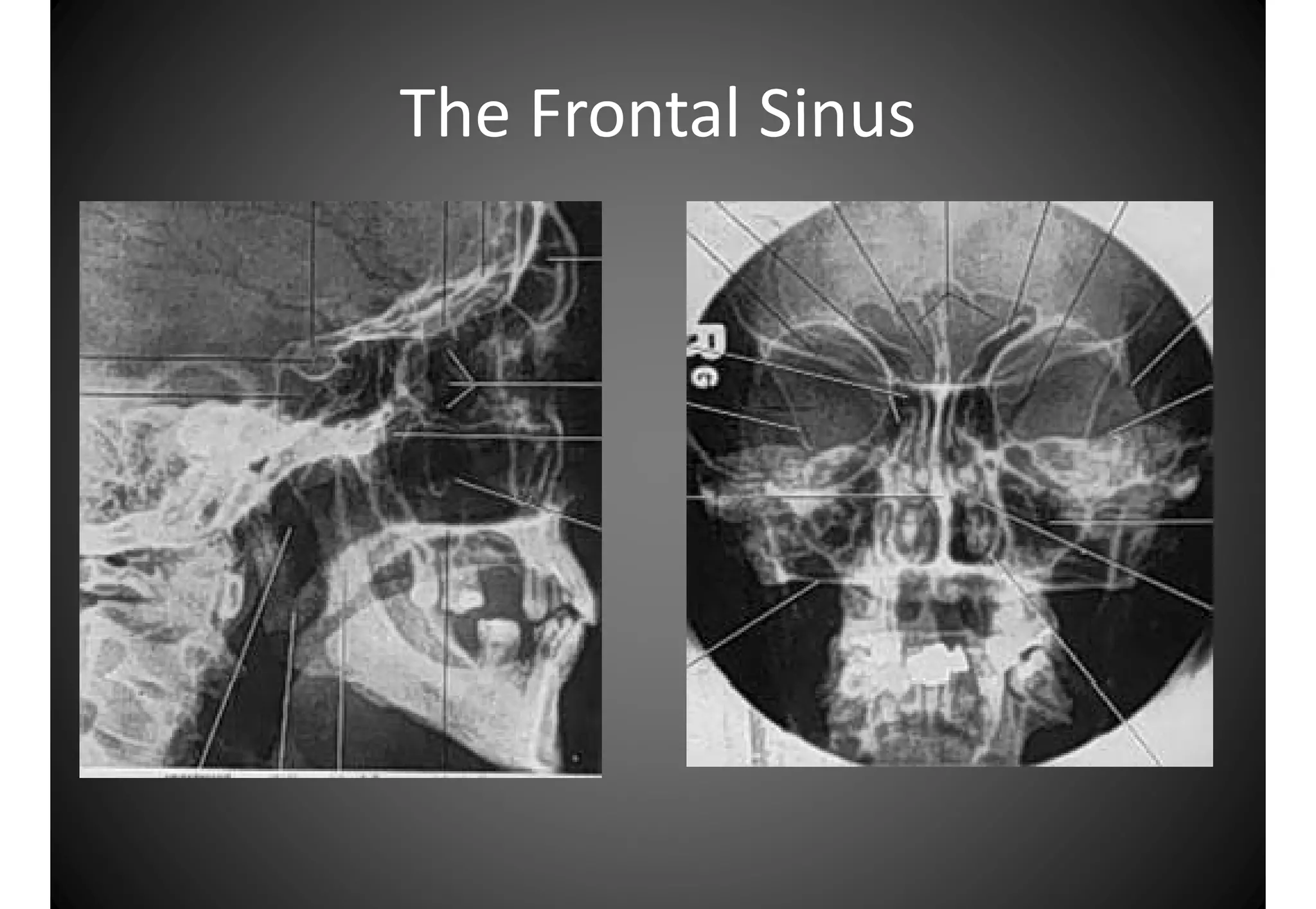 Atlas anatomy of the nose and paranasal sinuses | PDF