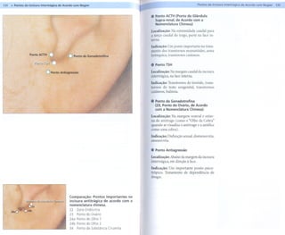 134 .. Pontos da Incisura Intertrágica de Acordo com Nogier                                                         Pontos dalncisura Intertrágica de Acordo com Nogier   135


                                                                                    .   Ponto ACTH (Ponto da Glândula
                                                                                        Supra-renal. de Acordo com a
                                                                                        Nomenclatura   Chinesa)

                                                                                    Localização: Na extremidade caudal para
                                                                                    o terço caudal do trago, parte na face in-
                                                                                    terna.

                                                                                    Indicação: Um ponto importante no trata-
                                                                                    mento dos transtornos reumatóides, asma
                  Ponto AaH                           da Gonadotrofina              brônquica, transtornos cutâneos.

                                                                                    . Ponto TSH

                              aponto   Antiagressão                                 Localização: Na margem caudal da incisura
                                                                                    intertrágica, na face interna.
                                                                                    Indicação: Transtornos da tireóide, trans-
                                                                                    tornos do trato urogenital, transtornos
                                                                                    cutâneos, bulimia.

                                                                                    . Ponto da Gonadotrofina
                                                                                      (23. Ponto do Ovário. de Acordo
                                                                                      com a Nomenclatura Chinesa)
                                                                                    Localização: Na margem ventral e exter-
                                                                                    na do antitrago (como o "Olho da Cobra"
                                                                                    quando se visualiza o antitrago e a antélice
                                                                                    como uma cobra).
                                                                                    Indicação: Disfunção sexual,dismenorréia,
                                                                                    amenorréia.

                                                                                    . Ponto Antiagressão
                                                                                    Localização: Abaixo da margem da incisura
                                                                                    intertrágica, em direção à face.
                                                                                    Indicação: Um importante ponto psico-
                                                                                    trópico. Tratamento de dependência de
                                                                                    drogas.




                                             Comparação: Pontos importantes na
                                             incisura antitrágica de acordo com a
                                             nomenclatura chinesa.
                                             22 ZonaEndócrina
                                             23 Pontodo Ovário
                                             24a Pontodo Olho 1
                                             24b Pontodo Olho 2
                                             34 Pontoda Substância  Cinzenta
 