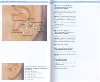 140 .. Pontos no Antitrago de Acordo com Nogier                                      t                                              PontO$ no Antitrago   de Acordo   com Nogier   141

                                                                                     ,.
                                                                                          ..   Ponto do Tálamo (26a, Ponto
                                                                                               da Hipófise, de Acordo com a
                                                                                               Nomenclatura   Chinesa)

                                                                                          Localização: Na parte interna do antitrago,
                                                                                          oposto ao Ponto do Osso Temporal (Ponto
                              DPo,oto   Zero                                              35, Ponto Solar).

                                                                                          Indicação: Um ponto analgésico geral que
                                                                                          afeta o lado ipsilateral do corpo: harmoni-
                      Linha                                                               zação neurovegetativa. Ejaculação precoce,
                                                                                          frigidez.
                                                                                          ~ No caso de reumatismo articular, utilizar
                                                                                            agulhas de ouro.
                                                                                          ~ Atenção! Contra-indicado    durante a ges-
                                                                                            tação.

                                                                                          .. Ponto do Osso Temporal
                                                                                             (35, Ponto Solar, de Acordo com a
                                                                                             Nomenclatura Chinesa)
                                                                                          Localização: No ponto médio do antitrago.
                                                                                          Indicação: Este ponto é utilizado com fre-
                                                                                          qüência. Cefaléia, enxaqueca, transtornos
                                                                                          oculares, vertigem, transtornos do sono.

                                                                                          .. Ponto do Osso Frontal

                                                                                          .. (33, Ponto da Fronte, de Acordo
                                                                                             com a Nomenclatura Chinesa)

                                                                                          Localização: Na parte ventral do antitrago.
                                                                                          Indicação: Transtornos (-algia, -ite) na área
                                                                                          da fronte.

                                                                                          .. Ponto da Articulação
                                                                                             Temporomandibular
                                                                                          Localização: Na extremidade caudal do Sul-
                                                                                          co Neurovegetativo.
                                               Comparação: Pontos importantes no          Indicação: Transtornos da articulação tem-
                                               antitrago de acordo com a nomencla-        poromandibular, cefaléia.
                                               tura chinesa.
                                               26a   Pontoda Hipófise
                                               30    Pontoda GlândulaParótida
                                               31    Pontoda Asma
                                               33    Pontoda Fronte
                                               34    Pontoda Substância
                                                                      Cinzenta
                                               35    PontoSolar
 
