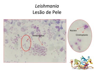 Leishmania
Lesão de Pele
Amastigotas
Núcleo
Cinetoplasto
 