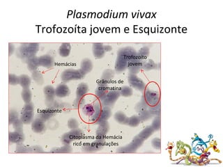 Plasmodium vivax
Trofozoíta jovem e Esquizonte
Esquizonte
Grânulos de
cromatina
Hemácias
Citoplasma da Hemácia
rico em granulações
Trofozoíto
jovem
 