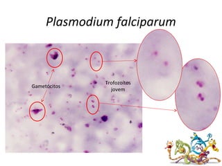 Plasmodium falciparum
Gametócitos
Trofozoítos
jovem
 