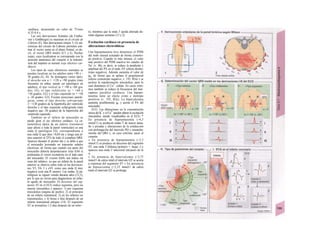 cardíaca, alcanzando un valor de 75/min
0,35-0,4 s.
Las seis derivaciones frontales (de Eintho-
ven y Goldberger) se muestran en el círculo de
Cabrera (E). Dos derivaciones (mejor 3; G) sin-
crónicas del círculo de Cabrera permiten esti-
mar el vector suma en el plano frontal, es de-
cir, el vector QRS medio (C3 y G, flechas
rojas), cuya localization se corresponde con la
posición anatómica del corazón si la transmi-
sión del impulso es normal («eje eléctrico car-
díaco»).
Los tipos de «ejes eléctricos» normales se
pueden localizar en los adultos entre +90 y -
30 grados (G, H). Se distinguen varios tipos:
el derecho con α = +120 a +90 grados (más
frecuente en niños, puede ser patológico en
adultos), el tipo vertical (a = +90 a +60 gra-
dos; Gl), el tipo indiferente (a = +60 a
+30 grados; G2) y el tipo izquierdo (α = +30
a -30 grados; G3). Existen posiciones patoló-
gicas, como el tipo derecho sobregirado
(> +120 grados) de la hipertrofia del ventrículo
derecho y el tipo izquierdo sofaregirado (más
negativo que -30 grados) de la hipertrofia del
ventrículo izquierdo.
También en el infarto de miocardio se
puede girar el eje eléctrico cardíaco. La ca-
racterística típica de un infarto transmural
(que afecte a toda la pared ventricular) es una
onda Q patológica (II), correspondiente a
una onda Q que dure >0,04 ms y tenga una al-
tura superior al 25% de todo el complejo QRS.
Aparece durante el primer día y se debe a que
el miocardio lesionado no transmite señales
eléctricas, de forma que cuando esa parte del
miocardio debería despolarizarse (tras 0,04 s)
predomina el vector excitatorio en el lado sano
del miocardio. El «vector 0,04» nos indica «la
zona del infarto», ya que un infarto de la pared
anterior se observa sobre todo en las derivacio-
nes V5, V6, I y aVL como una onda Q muy
negativa (con una R menor). Las ondas, Q pa-
tológicas se siguen viendo durante años (12,3),
por lo que no sirven para diagnosticar un infar-
to agudo de miocardio. El descenso del seg-
mento ST en el ECG indica isquemia, pero no
muerte miocárdica y aparece: 1) por isquemia
miocárdica (angina de pecho); 2) al principio
de un infarto transmural; 3) en los infartos no
transmurales, y 4) horas o días después de un
infarto transmural antiguo (14). El segmento
ST se normaliza 1-2 días después de un infar-
to, mientras que la onda T queda alterada du-
rante algunas semanas (15 y 2).
Excitación cardíaca en presencia de
alteraciones electrolíticas
Una hipopotasemia leve disminuye el PDM
del nodo sinusal actuando de forma cronotro-
po positiva. Cuando es más intensa, el valor
más positivo del PDM inactiva los canales de
Na+
(v. 46), es decir, se reduce la pendiente y
amplitud del PA en el nodo AV (efecto dromo-
tropo negativo). Además aumenta el valor de
gK, de forma que se aplana el prepotencial
(efecto cronotropo negativo; v. 193, B3a) y se
acelera la repolarización miocárdica, para lo
cual disminuye el Ca2+
celular. En casos extre-
mos también se reduce la frecuencia del mar-
capasos (parálisis cardíaca). Una hipopo-
tasemia tiene un efecto crono e inotropo
positivos (v. 193, B3a). La hipercalcemia
aumenta posiblemente gK y acorta el PA del
miocardio.
ECG. Las alteraciones en la concentración
sérica del K+
y el Ca2+
pueden alterar la excitación
miocárdica, siendo visualizables en el ECG: *
En presencia de hiperpotasemia (>6,5
mmol/1) se producen ondas T de mayor tama-
ño y picudas y alteraciones de la conducción
con prolongación del intervalo PQ y ensancha-
miento del QRS y, en caso extremo, parar el
corazón.
» En presencia de hipopotasemia (<2,5
mmol/1) se produce un descenso del segmento
ST, una onda T bifásica (primero +, luego -) y
aparece una onda U adicional (después de la
η.
» En presencia de hipercalcemia (>2,75
mmol/1 de calcio total) el intervalo QT se acorta
a expensas del segmento ST » En presencia
de hipoca/cemia (<2,25 mmol/1 de calcio
total) el intervalo QT se prolonga.
 