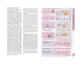 Alteraciones del ritmo cardíaco
Las alteraciones del ritmo (arritmias) y las alte-
raciones en la génesis o transmisión del estí-
mulo se pueden visualizar en el ECG.
Las alteraciones de la génesis del estí-
mulo modifican el ritmo sinusal. Si se produce
un incremento de la frecuencia sinusal por
encima de 100/min (p. ej., en el esfuerzo físi-
co, con la excitación, la fiebre (aumento de
10 mirr1
por cada 0
C) y el hipertiroidismo). se
habla de taquicardia sinusa/ (A2). Si se redu-
ce por debajo de 60/min (en el hipotirodismo),
se denomina bradicardia sinusa/. En ambos ca-
sos el ritmo es regular, mientras que en la arrit-
mia sinusa/ la frecuencia cambia. La arritmia si-
nusal aparece de forma fisiológica en los jóvenes
y depende de la respiración: la inspiración acelera
la frecuencia y la espiración la disminuye.
Origen ectópico de los estímulos.
Aunque el nodo sinusal genere estímulos con
normalidad (A) se pueden producir otros es-
tímulos ectópícos (= heterotópicos) a partir de
focos en la aurícula (atrial), el nodo AV (nodal)
o el ventrículo (uentricu/arj. La aparición de un
foco atrial de elevada frecuencia provoca una
taquicardia auricular (linea basal en dientes
de sierra en lugar de una onda P), a la que el
ventrículo sigue hasta una frecuencia de 200/
min. Después sólo se transmite uno de cada 2 o
3 estímulos, porque los restantes se producen
en la fase refractaria de las zonas con un poten-
cial de acción más prolongado (sobre todo las fi-
bras de Purkinje), que se comportan como un
filtro de frecuencias. Cuando la frecuencia
auricular alcanza los 350/min se habla de flú-
ter auricular y cuando supera esta cifra de fi-
brilación auricular (hasta 500/min). La exci-
tación ventricular en este momento sería com-
pletamente irregular (arritmia absoluta). La
taquicardia ventricular es una producción rá-
pida de estímulos a nivel ventricular (éctópicos),
que empieza con una extrasístole (ES, B3; se-
gunda ES). Se altera la capacidad de llenado y
eyección cardíaca y puede culminar en una flbri-
lación ventricular, caracterizada por contrac-
ciones incoordinadas de alta frecuencia del mio-
cardio (B4). Si no se adoptan medidas contra
esta situación, el riesgo vital es parecido al del
paro cardíaco por la falta de aporte sanguíneo.
La fibrilación ventricular se produce cuando Ia extrasístole
coincide con Ia fase vulnerable del PA previo (fase
refractaria relativa, sincrónica con Ia onda T del ECG; v.
193, A). Los PA desencadenados en esta
fase tienen a) una pendiente menor, por Io que se
transmiten de una forma más lenta, y b) duran menos.
Ambas características justifican que Ia excitación siempre
encuentre una zona de miocardio excitable (círculo
excitatorio = reentrada). La fibrilación ventricular se
puede producir por un accidente eléctrico y se puede
recuperar con una corriente eléctrica aplicada en el lado
derecho (desfibrílador).
Extrasístoles (ES). Cuando los impulsos de un foco
ectópico auricular o nodal (= supraventricuiar) se transmiten
hacia los ventrículos, éstos pueden abandonar el ritmo
sinusal: arritmia supraventricuiar. Cuando Ia ES es
auricular Ia onda P del ECG está deformada, pero el
complejo QRS es normal. En las ES nodales las aurículas
se excitan de forma retrógrada, por Io que las ondas P son
negativas y se incorporan al complejo QRS o aparecen
poco después del mismo (B1, derecha). Como las ES
supraventri-culares también suelen descargar el nodo
sinusal, aumenta el intervalo entre las ondas R en las
ES (= RES) y Ia siguiente onda R normal por el tiempo que
tarda el estímulo desde el foco al nodo sinusal: pausa
postextrasistole. Por tanto, se cumple para el intervalo RR:
RESR > RR y (RRES + RESR) < 2 RR (B1).
En Ia ES ventricular (B2,3) el complejo QRS de Ia ES
aparece deformado. Cuando Ia frecuencia sinusal es baja, el
siguiente estímulo sinusal llega sin alteraciones a los
ventrículos: ES interpuesta (B2). Cuando Ia frecuencia
sinusal es alta el siguiente estímulo sinusal llega al
ventrículo, mientras éste se encuentra todavía en periodo
refractario, de forma que sólo el siguiente estímulo sinusal
será eficaz: pausa compensadora. Por eso, RRES + RESR = 2
RR.
Alteraciones de la transmisión del estímu-
lo: bloqueo AV. En el bloqueo AV de grado !
se produce una transmisión del estímulo anor-
malmente lenta (intervalo PQ > 0,2 s), en el blo-
queo de grado ¡I sólo se transmite uno de cada 2
o 3 estímulos y en el de grado /// se produce un
bloqueo completo. En este último el corazón lle-
garía a pararse (crisis de Adam-Stokes), por lo
que el ventrículo asume el papel de marcapasos
(bradicardia ventricular con una frecuencia auri-
cular normal). Como consecuencia, las ondas P
aparecen de forma independiente del complejo
QRS (B5). La frecuencia cardíaca disminuye hasta
40-55/min, cuando el papel de marcapasos lo
asume el nodo AV (B5) o a sólo 25-40/min
cuando lo hace el denominado marcapasos ter-
ciario (ventricular). Un marcapasos artificial
consigue buenos resultados en esta situación.
El bloqueo de rama (alteraciones de Ia conducción en el
haz de Tawara) provoca Importantes alteraciones en Ia
forma del complejo QRS, porque el lado del miocardio
afectado se excita por vías anómalas a partir del sano.
 
