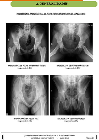 Lowenstein Rx Atlas de cadera | PDF