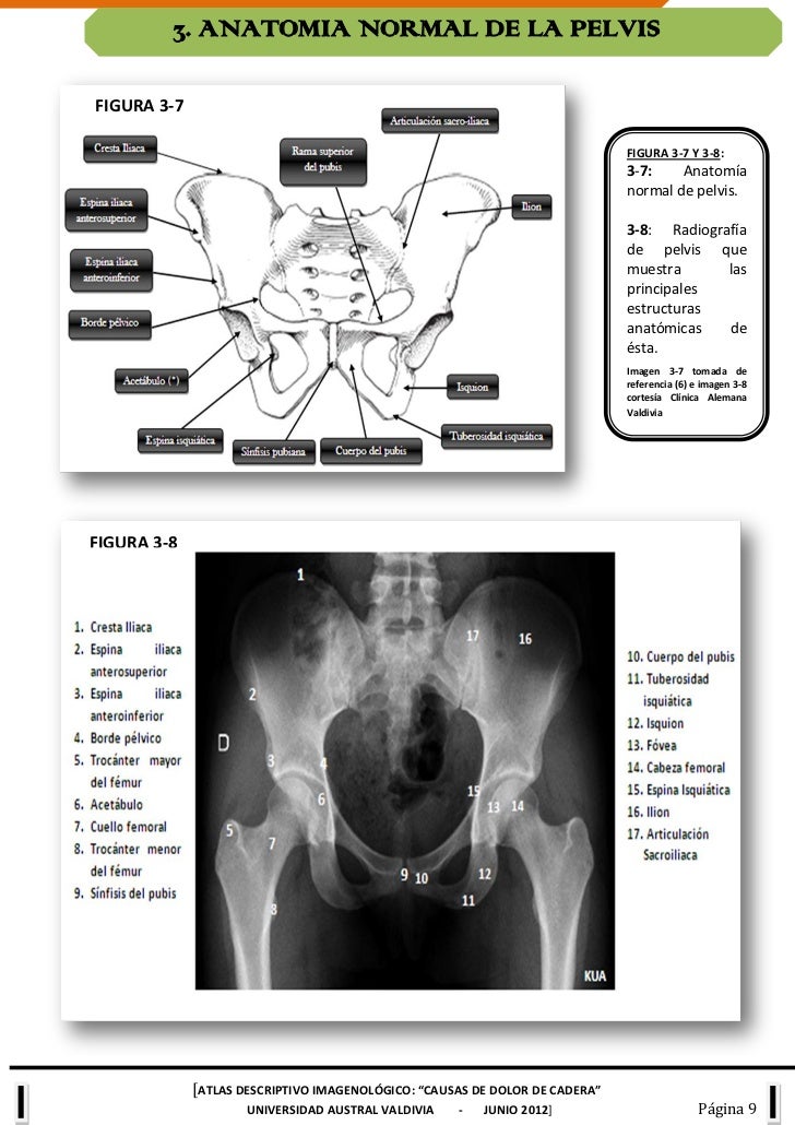 picture Radiografia De Cadera Normal atlas de cadera