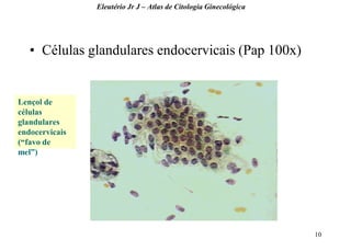 10 
•Células glandulares endocervicais (Pap 100x) 
Eleutério Jr J – Atlas de Citologia Ginecológica 
Lençol de células glandulares endocervicais (“favo de mel”)  