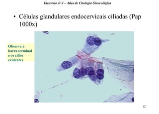 12 
•Células glandulares endocervicais ciliadas (Pap 1000x) 
Eleutério Jr J – Atlas de Citologia Ginecológica 
Observe a barra terminal e os cílios evidentes  
