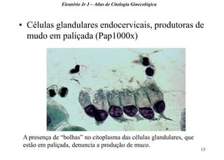 13 
•Células glandulares endocervicais, produtoras de mudo em paliçada (Pap1000x) 
Eleutério Jr J – Atlas de Citologia Ginecológica 
A presença de “bolhas” no citoplasma das células glandulares, que estão em paliçada, denuncia a produção de muco.  