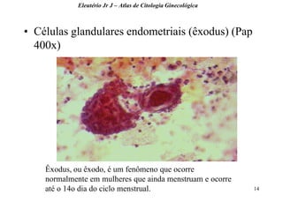 14 
•Células glandulares endometriais (êxodus) (Pap 400x) 
Eleutério Jr J – Atlas de Citologia Ginecológica 
Êxodus, ou êxodo, é um fenômeno que ocorre normalmente em mulheres que ainda menstruam e ocorre até o 14o dia do ciclo menstrual.  