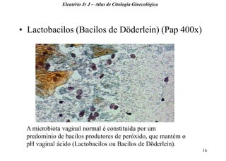 16 
•Lactobacilos (Bacilos de Döderlein) (Pap 400x) 
Eleutério Jr J – Atlas de Citologia Ginecológica 
A microbiota vaginal normal é constituída por um predomínio de bacilos produtores de peróxido, que mantém o pH vaginal ácido (Lactobacilos ou Bacilos de Döderlein).  