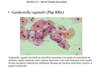 17 
•Gardnerella vaginalis (Pap 400x) 
Eleutério Jr J – Atlas de Citologia Ginecológica 
Gardnerella vaginalis são bactérias anaeróbias associadas a um quadro de anaerobiose do ambiente vaginal conhecido como vaginose bacteriana. Com certa frequencia neste quadro há uma leucopenia, induzida por substâncias liberadas por bactérias anaeróbias, inclusive a própria Gardnerella.  