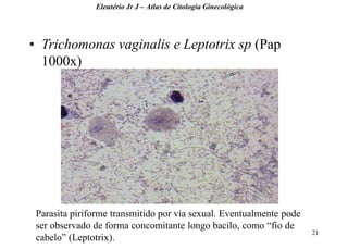 21 
•Trichomonas vaginalis e Leptotrix sp (Pap 1000x) 
Eleutério Jr J – Atlas de Citologia Ginecológica 
Parasita piriforme transmitido por via sexual. Eventualmente pode ser observado de forma concomitante longo bacilo, como “fio de cabelo” (Leptotrix).  