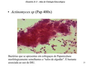 23 
•Actinomyces sp (Pap 400x) 
Eleutério Jr J – Atlas de Citologia Ginecológica 
Bactérias que se apresentas em esfregaços de Papanicolaou morfologicamente semelhantes a “tufos de algodão”. É bastante associada ao uso de DIU.  