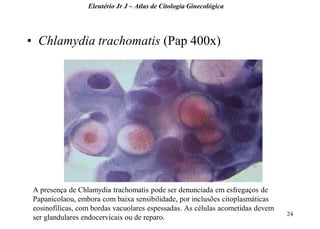 24 
•Chlamydia trachomatis (Pap 400x) 
Eleutério Jr J – Atlas de Citologia Ginecológica 
A presença de Chlamydia trachomatis pode ser denunciada em esfregaços de Papanicolaou, embora com baixa sensibilidade, por inclusões citoplasmáticas eosinofílicas, com bordas vacuolares espessadas. As células acometidas devem ser glandulares endocervicais ou de reparo.  