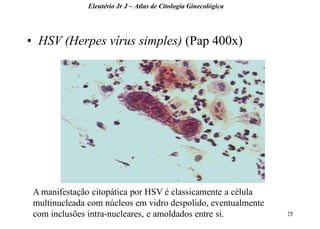 25 
•HSV (Herpes vírus simples) (Pap 400x) 
Eleutério Jr J – Atlas de Citologia Ginecológica 
A manifestação citopática por HSV é classicamente a célula multinucleada com núcleos em vidro despolido, eventualmente com inclusões intra-nucleares, e amoldados entre si.  