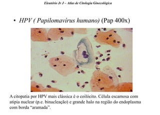 26 
•HPV ( Papilomavírus humano) (Pap 400x) 
Eleutério Jr J – Atlas de Citologia Ginecológica 
A citopatia por HPV mais clássica é o coilócito. Célula escamosa com atipia nuclear (p.e. binucleação) e grande halo na região do endoplasma com borda “aramada”.  