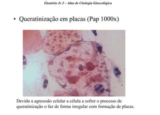 28 
•Queratinização em placas (Pap 1000x) 
Eleutério Jr J – Atlas de Citologia Ginecológica 
Devido a agresssão celular a célula a sofrer o processo de queratinização o faz de forma irregular com formação de placas.  