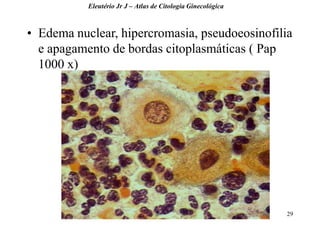 29 
•Edema nuclear, hipercromasia, pseudoeosinofilia e apagamento de bordas citoplasmáticas ( Pap 1000 x) 
Eleutério Jr J – Atlas de Citologia Ginecológica  