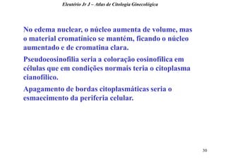 30 
No edema nuclear, o núcleo aumenta de volume, mas o material cromatínico se mantém, ficando o núcleo aumentado e de cromatina clara. Pseudoeosinofilia seria a coloração eosinofílica em células que em condições normais teria o citoplasma cianofílico. Apagamento de bordas citoplasmáticas seria o esmaecimento da periferia celular. 
Eleutério Jr J – Atlas de Citologia Ginecológica  
