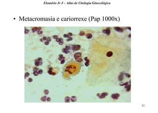 31 
•Metacromasia e cariorrexe (Pap 1000x) 
Eleutério Jr J – Atlas de Citologia Ginecológica  