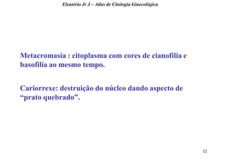 32 
Metacromasia : citoplasma com cores de cianofilia e basofilia ao mesmo tempo. Cariorrexe: destruição do núcleo dando aspecto de “prato quebrado”. 
Eleutério Jr J – Atlas de Citologia Ginecológica  