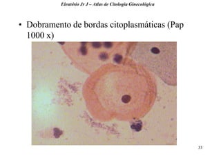 33 
•Dobramento de bordas citoplasmáticas (Pap 1000 x) 
Eleutério Jr J – Atlas de Citologia Ginecológica  