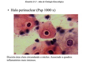 36 
•Halo perinuclear (Pap 1000 x) 
Eleutério Jr J – Atlas de Citologia Ginecológica 
Discreta área clara circundando o núcleo. Associado a quadros inflamatórios mais intensos.  