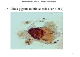 37 
•Célula gigante multinucleada (Pap 400 x) 
Eleutério Jr J – Atlas de Citologia Ginecológica  