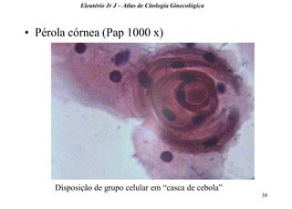 38 
•Pérola córnea (Pap 1000 x) 
Eleutério Jr J – Atlas de Citologia Ginecológica 
Disposição de grupo celular em “casca de cebola”  
