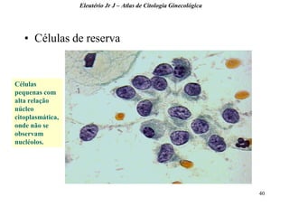 40 
•Células de reserva 
Eleutério Jr J – Atlas de Citologia Ginecológica 
Células pequenas com alta relação núcleo citoplasmática, onde não se observam nucléolos.  