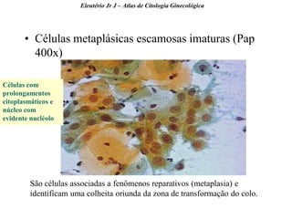 41 
•Células metaplásicas escamosas imaturas (Pap 400x) 
Eleutério Jr J – Atlas de Citologia Ginecológica 
Células com prolongamentos citoplasmáticos e núcleo com evidente nucléolo 
São células associadas a fenômenos reparativos (metaplasia) e identificam uma colheita oriunda da zona de transformação do colo.  