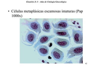 42 
•Células metaplásicas escamosas imaturas (Pap 1000x) 
Eleutério Jr J – Atlas de Citologia Ginecológica  