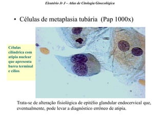 43 
•Células de metaplasia tubária (Pap 1000x) 
Eleutério Jr J – Atlas de Citologia Ginecológica 
Células cilíndrica com atipia nuclear que apresenta barra terminal e cílios 
Trata-se de alteração fisiológica de epitélio glandular endocervical que, eventualmente, pode levar a diagnóstico errôneo de atipia.  