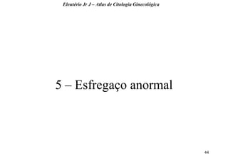 44 
5 – Esfregaço anormal 
Eleutério Jr J – Atlas de Citologia Ginecológica  