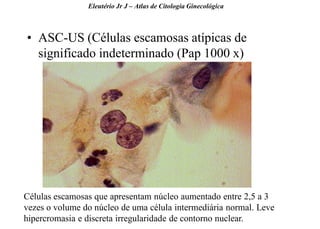 45 
•ASC-US (Células escamosas atípicas de significado indeterminado (Pap 1000 x) 
Eleutério Jr J – Atlas de Citologia Ginecológica 
Células escamosas que apresentam núcleo aumentado entre 2,5 a 3 vezes o volume do núcleo de uma célula intermediária normal. Leve hipercromasia e discreta irregularidade de contorno nuclear.  