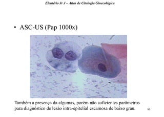 46 
•ASC-US (Pap 1000x) 
Eleutério Jr J – Atlas de Citologia Ginecológica 
Também a presença da algumas, porém não suficientes parâmetros para diagnóstico de lesão intra-epitelial escamosa de baixo grau.  