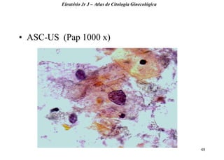 48 
•ASC-US (Pap 1000 x) 
Eleutério Jr J – Atlas de Citologia Ginecológica  
