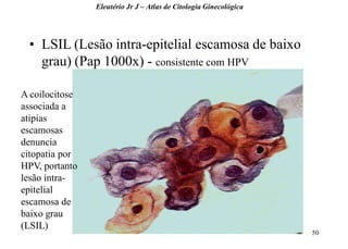 50 
•LSIL (Lesão intra-epitelial escamosa de baixo grau) (Pap 1000x) - consistente com HPV 
Eleutério Jr J – Atlas de Citologia Ginecológica 
A coilocitose associada a atipias escamosas denuncia citopatia por HPV, portanto lesão intra- epitelial escamosa de baixo grau (LSIL)  